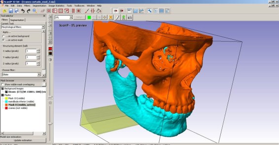 APLICA IPN INDUSTRIA 4.0 PARA GENERAR IMPLANTES PERSONALIZADOS (1).jpg